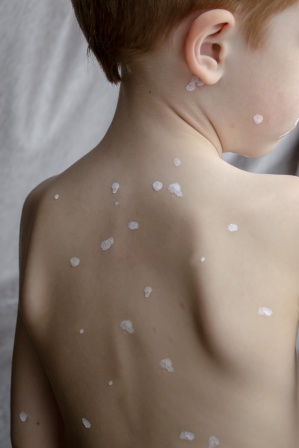 Andrej Medveď - Čo použiť na kiahne? 