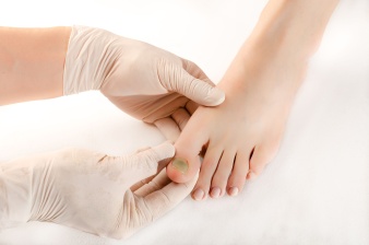 Andrej Medveď - Ako je to s tými plesňami na nohách? Prečo sa tvoria a ľudia sa ich nevedia zbaviť?